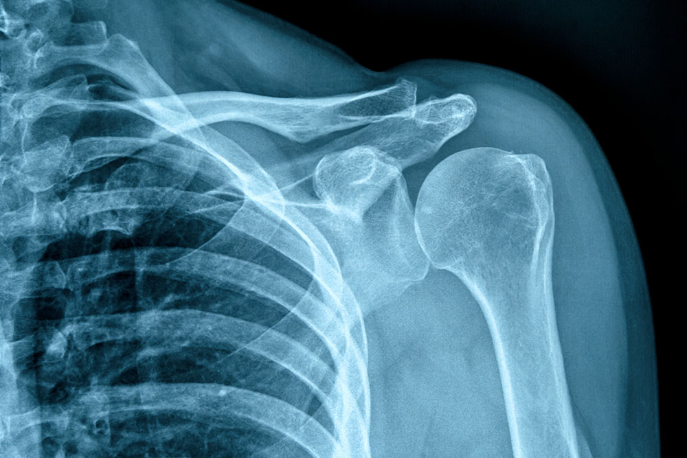 X-rays