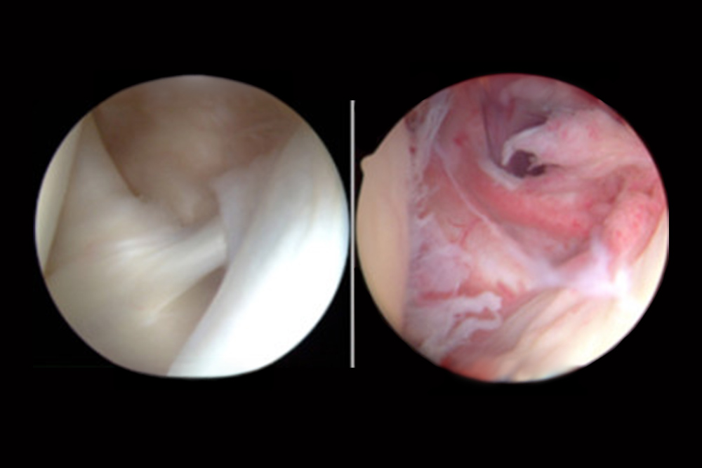 Shoulder Arthroscopy